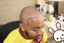 点击看大图 -大麦微针植发丨全国连锁