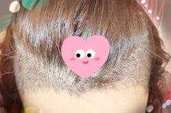 -大麦微针植发全国连锁