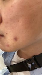 -痣斑堂·取大痣