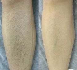 -薇兰专业脱毛连锁机构