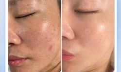 -美肤盾祛痘·问题肌头疗管理中心