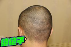 -大麦微针植发丨全国连锁