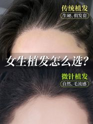 -大麦微针植发全国连锁
