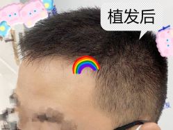 -大麦微针植发全国连锁