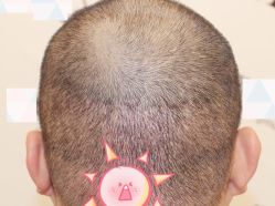 -大麦微针植发全国连锁