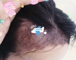 -大麦微针植发全国连锁