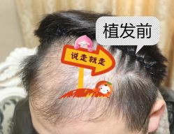 -大麦微针植发全国连锁