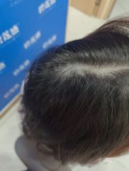 -碧莲盛不剃发植发