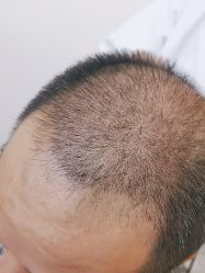 点击看大图 -大麦微针植发全国连锁