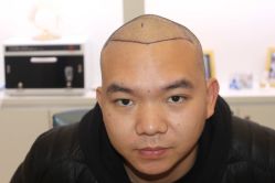 -大麦微针植发丨全国连锁