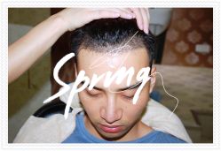 点击看大图 体验后-大麦微针植发全国连锁