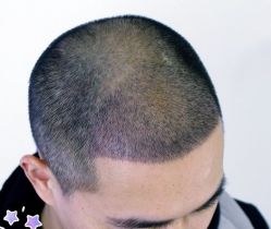 -大麦微针植发丨全国连锁