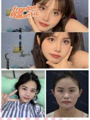 体验后-成都西区医院整形美容
