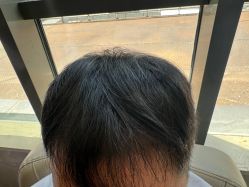 -碧莲盛·不剃发植发