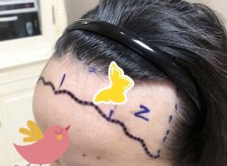 -大麦微针植发全国连锁