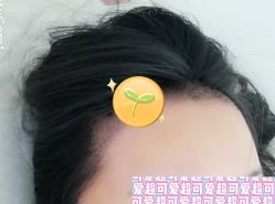 -大麦微针植发全国连锁