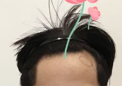-大麦微针植发全国连锁
