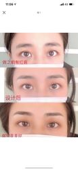 体验后-郡艺医疗美容·微整·眼鼻吸脂