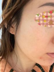 体验后-新美荟医美·专注面部美学抗衰