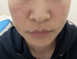 体验前-郡艺医疗美容·微整·眼鼻吸脂