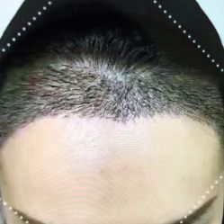 体验后-熙朵美学植发·连锁品牌