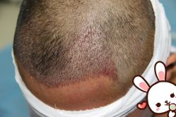 点击看大图 -大麦微针植发丨全国连锁