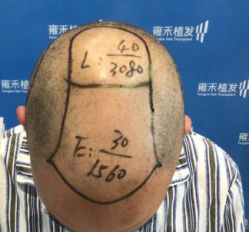 -雍禾植发全国连锁