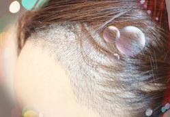 -大麦微针植发全国连锁