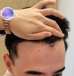 -大麦微针植发丨全国连锁