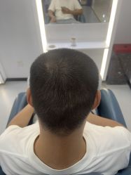 -大麦微针植发全国连锁