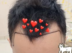 -大麦微针植发全国连锁