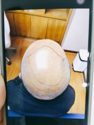 -大麦微针植发全国连锁