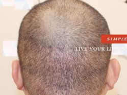 -大麦微针植发全国连锁