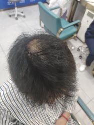 -碧莲盛不剃发植发