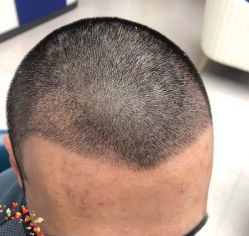 -大麦微针植发丨全国连锁