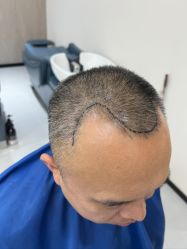 体验前-大麦微针植发全国连锁