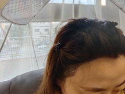 -碧莲盛·不剃发植发