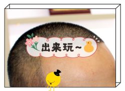 -大麦微针植发全国连锁
