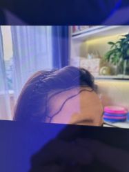 -碧莲盛·不剃发植发