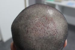 点击看大图 -大麦微针植发丨全国连锁