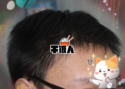 -大麦微针植发全国连锁