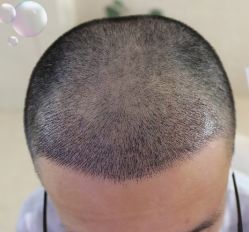 -大麦微针植发丨全国连锁