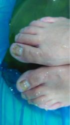 upload_pic-EPAI·灰指甲·甲沟炎·嵌甲护理