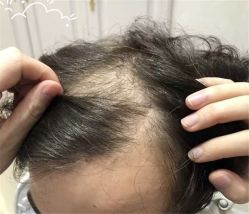 -大麦微针植发全国连锁