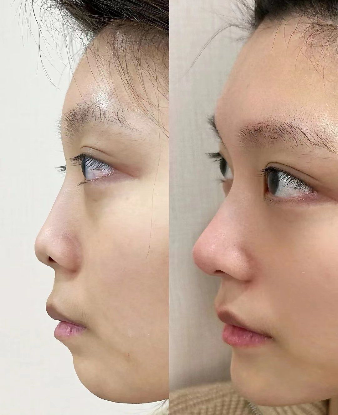 注射隆鼻,为什么会透光?