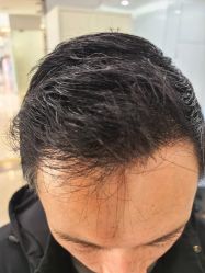 -大麦微针植发丨全国连锁