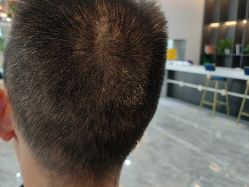-碧莲盛·不剃发植发