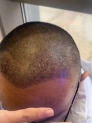 -碧莲盛·不剃发植发