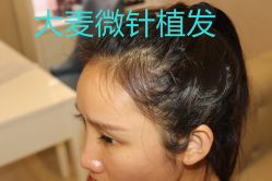 -大麦微针植发丨全国连锁