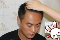 点击看大图 -大麦微针植发丨全国连锁